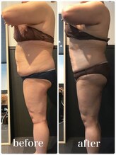 ピーラトゥ 日立(P-Ratu)/脂肪冷却◆