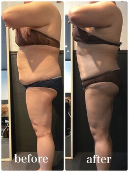 ピーラトゥ 日立(P-Ratu)/脂肪冷却◆