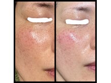 一回トーニングケアにて美肌！美白