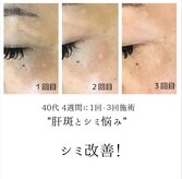 シミリセット 名駅(シミReset)