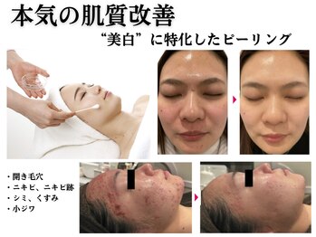 スパイア(SPIRE)の写真/美白に特化したピーリングでニキビ・シミ・くすみ・毛穴にアプローチ！あらゆる肌悩みを一気に改善！
