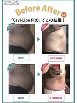 ルピエ(Lupir)/ビフォーアフター