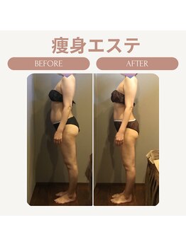 ムーン(MOON)/痩身エステ全身