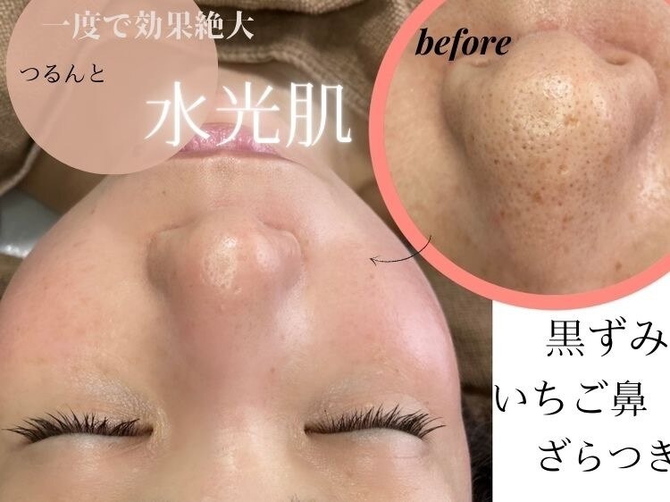 【フェイシャル】黒ずみ毛穴《ピーリング＋毛穴洗浄×小顔造形》　\8800→