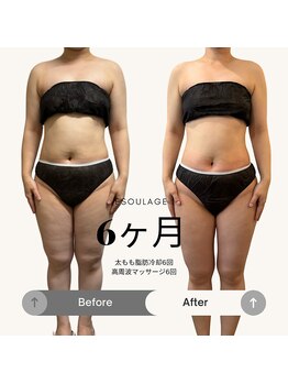 エスラージュ(esoulage)/脂肪冷却　太もも
