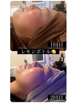 リラクゼーションサロンブラン(Bulan)/レモンボトル