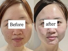 レシェルサロン(Lechelle Salon)/ハイパーナイフ小顔脂肪燃焼