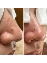 毛穴ピーリングケア＆小顔専門サロン　R.a【アルエ】/【毛穴エクストラクション】