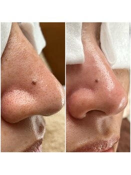 毛穴ピーリングケア＆小顔専門サロン　R.a【アルエ】/【毛穴エクストラクション】