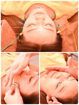 マイアート(My Art)の写真/《美容鍼＋小顔矯正＋首肩リンパマッサージ》で驚きの変化！小顔に特化した技術で理想の小顔へ導きます！