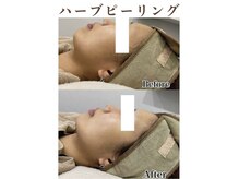 ティアム バイ テトテ 神戸三宮(TIAM by tetote)/ハーブピーリング