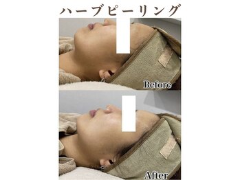 ティアム バイ テトテ 神戸三宮(TIAM by tetote)/ハーブピーリング