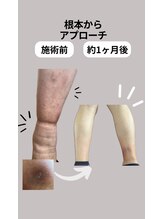 アイヲン(Aiwon)/【むくみ】ビフォーアフター