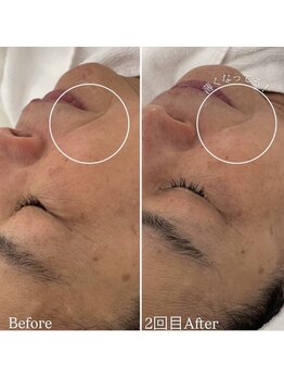 ミエル 神戸店(Miel)/ほうれい線改善はこれ！