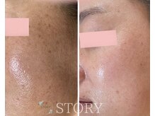 ストーリー 岐阜店(STORY)/ハーブピーリング専門店STORY