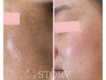 ストーリー 岐阜店(STORY)/ハーブピーリング専門店STORY