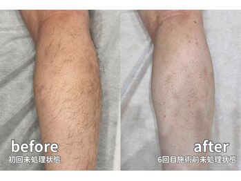 シェアサロン レノール(SHARE SALON LENORL)/【momiji】メンズ 脚脱毛