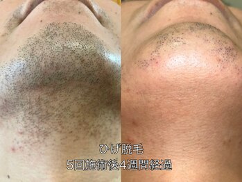 エクレ 柏店(EKURE)/ヒゲ脱毛