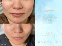 エステ版オンダマシン【エルテオンリフト】Before /After