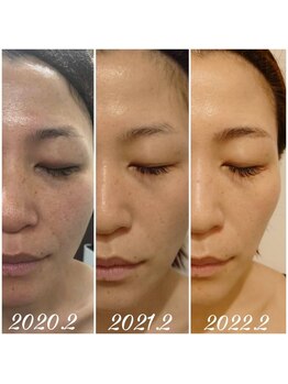 エステサロンブランシュ(Esthe salon Blanche)/ハーブピーリングでくすみケア