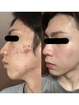 エステサロン 美飾り イオンモール木更津店/before⇒after/プラズマ