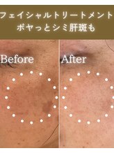 ココロ(COCORO)/ボヤッとシミも