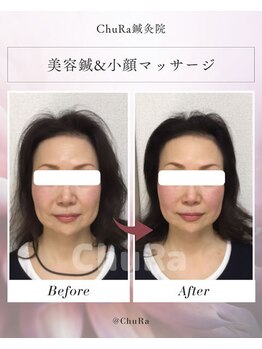 チュラ鍼灸院 西宮北口(ChuRa鍼灸院)/美容鍼&小顔マッサージ