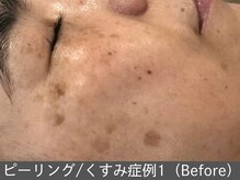 オアシスラグーン(OASIS LAGOON)/ピーリング（症例1 before）60代