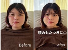 ミラ 中央林間(mira)/小顔 毛穴 ほうれい線 ハリ弾力
