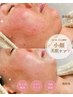 【速攻小顔】むくみ解消×リフトUPフェイシャル　￥16,500→￥11,000
