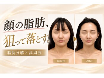 エン 橿原店(en)の写真/「痩せても顔だけ変わらない…」気になる丸顔・二重あごに。余分な脂肪にさようなら◎くっきりV字輪郭へ