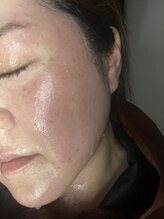 アットウィル 志木店(at will)/よもぎ蒸しで大量発汗！！