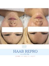 フルアナ(Hu ruana)/ハーブピーリング