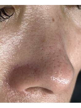 シアー(sHeeR)/毛穴エクストレクション