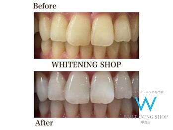 ホワイトニングショップ 甲賀店/Before&After『ホワイトニング』