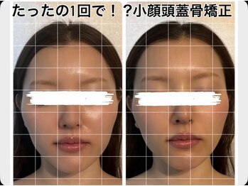 ビノスビューティー(vinos.beauty)の写真/《たるみ改善リの時短高効果ケア》一度で見違えるリフトアップは世界初最新機器NR小顔筋膜リペアで実現！