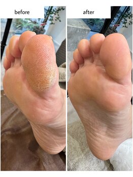 ケアプラス(care plus)/足裏角質ケア