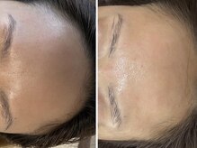 ラヴィ(Ravi)/カサカサ乾燥肌改善