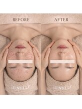 ルネル(Lunelle)/1か月に一回のケアがとても大切