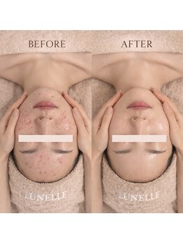 ルネル(Lunelle)/1か月に一回のケアがとても大切