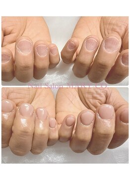 マリーシーオー(MARY-CO.)/深爪矯正