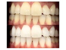 セルフダック いわき平店(SELFDUCK)/◇ホワイトニングの症例写真3