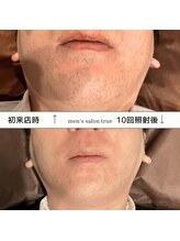 トゥルー(true)/ヒゲ脱毛　8回照射