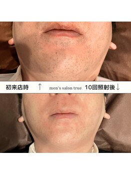 トゥルー(true)/ヒゲ脱毛　8回照射