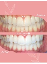 エクシアホワイトニング 札幌中島公園店/ホワイトニングビフォーアフター