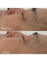 ミエル 神戸店(Miel)/目元の皺もこんなに変わる！