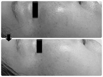 エフェクト 塚口店(effect)/Before After 20代/2回目