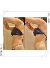 スキンホリック 恵比寿駅前店(SKIN HOLIC)/お腹☆ビフォア＆アフター★