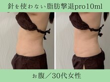 ソルニス(Solnis.)/痩身☆脂肪分解/ハイパーナイフ