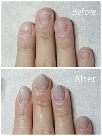 深爪矯正ジェルスカルプ長さだし